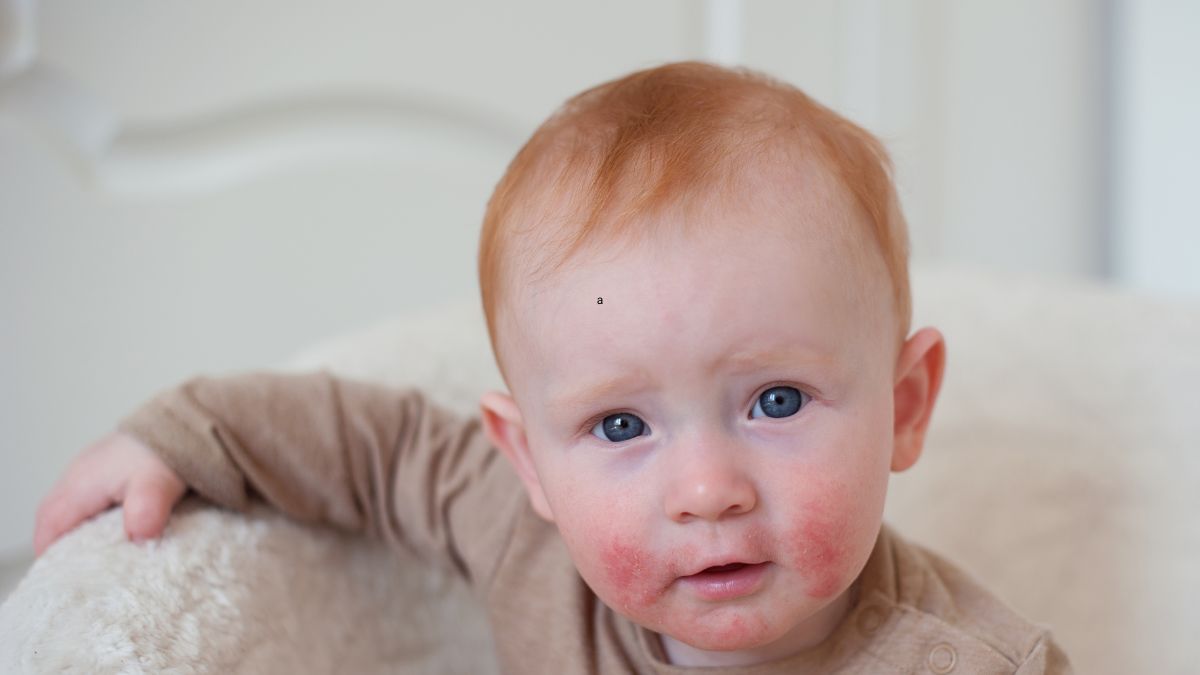 Dieťa s atopickým ekzémom. Zdroj foto: Canva